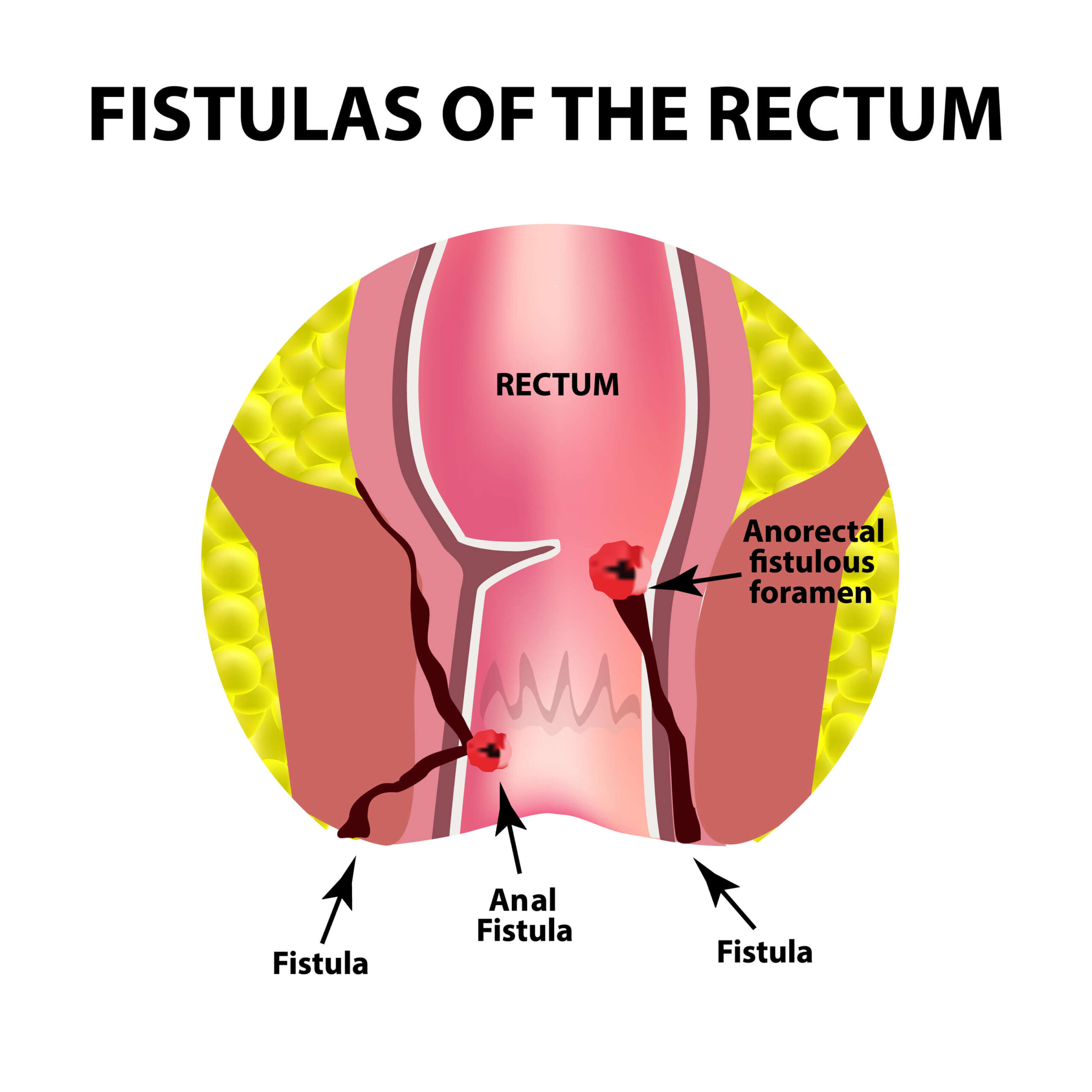 Fistula of the Rectum - Anal Fistula Treatment in Singapore