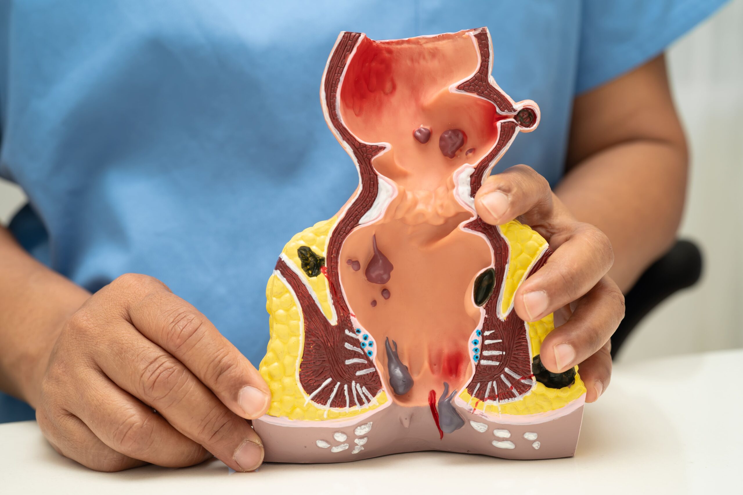 anal fistula specialist
